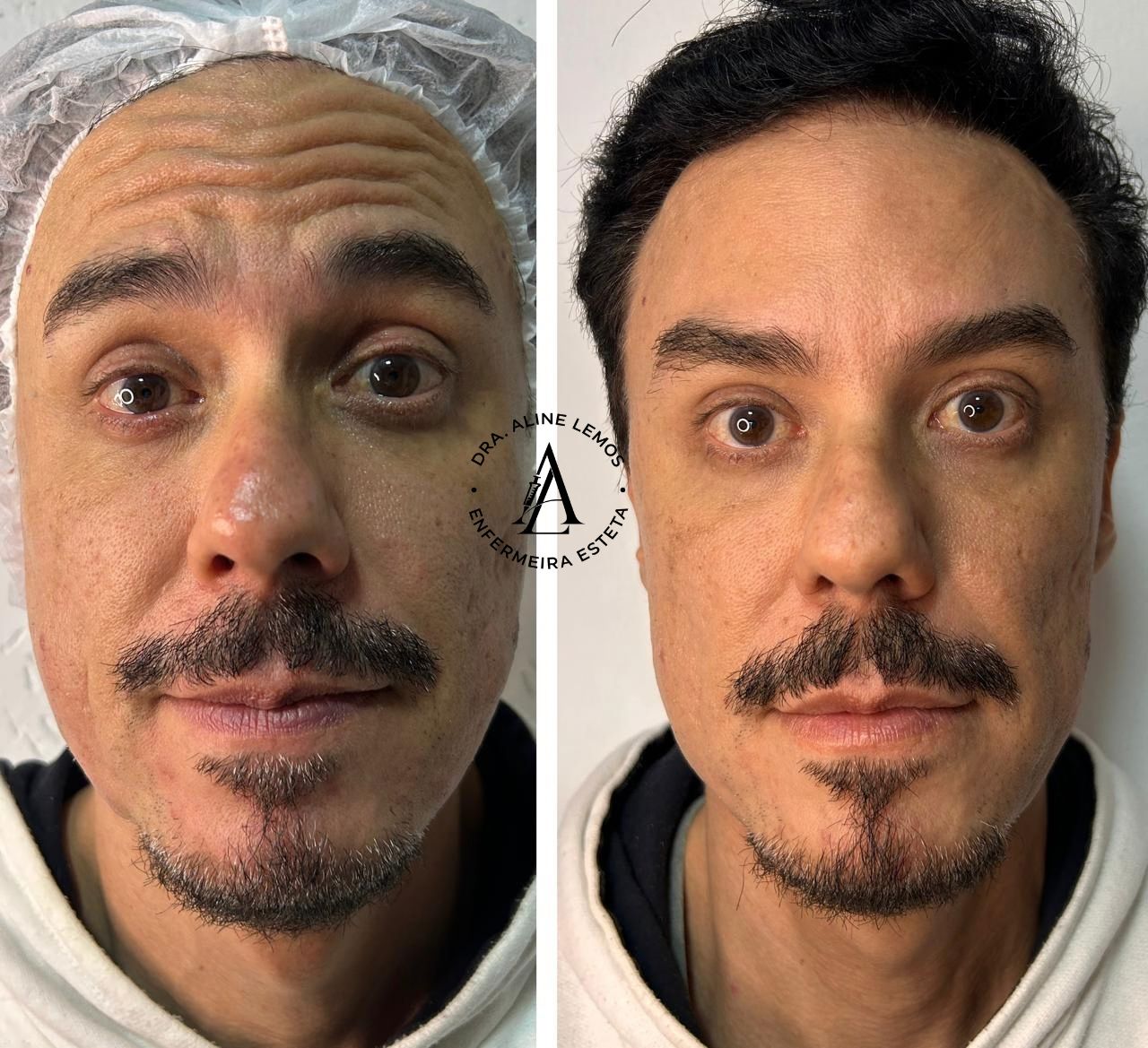 Antes e depois — Testa e olhar