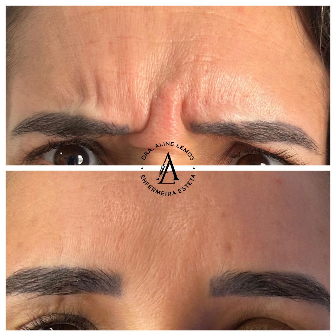 Antes e depois — Entre as sobrancelhas