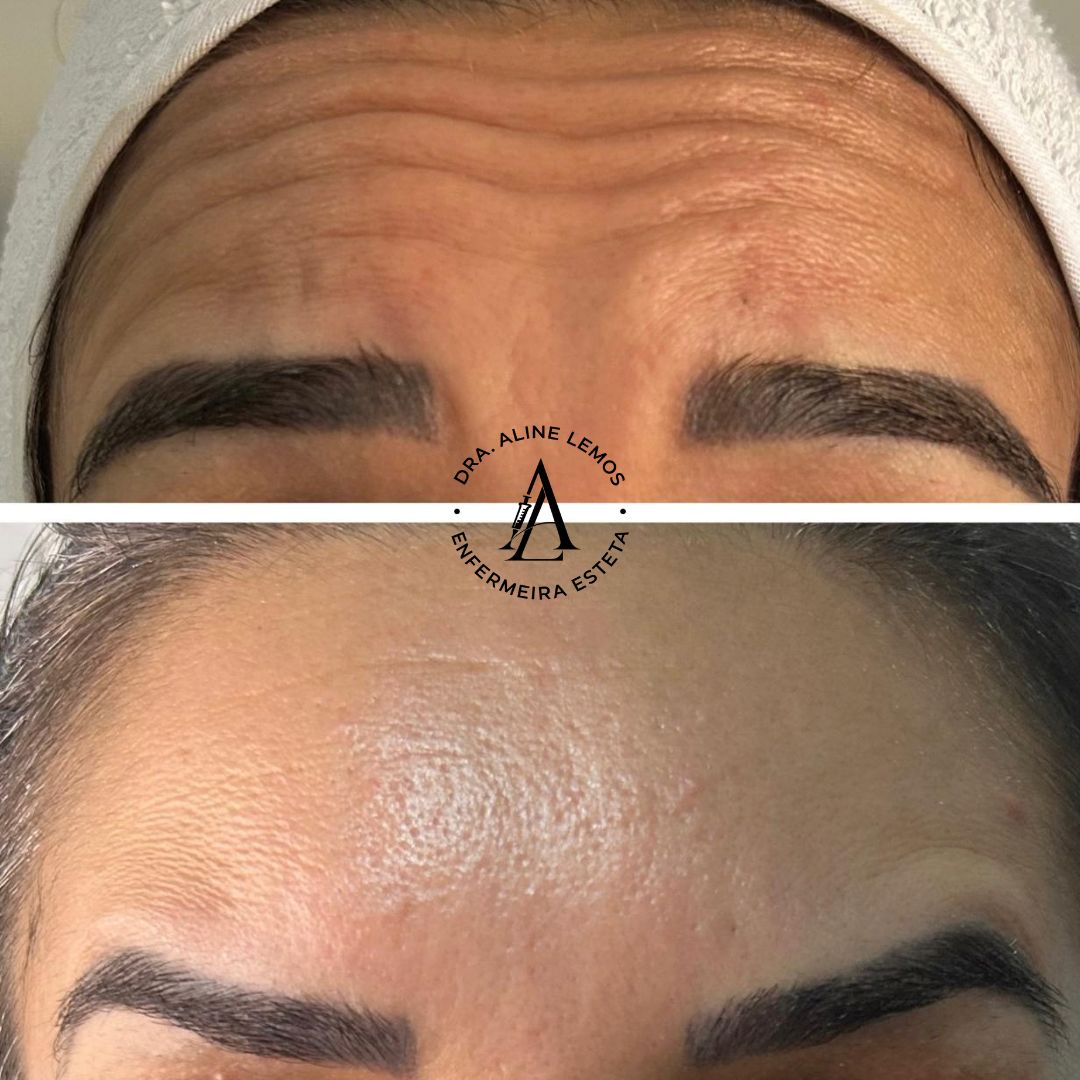 Antes e depois — Testa