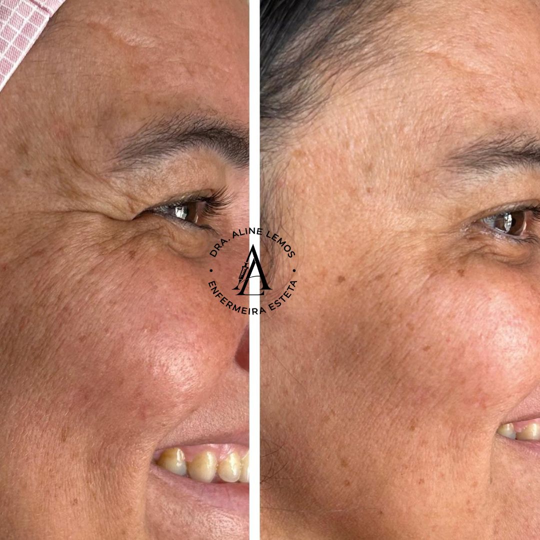 Antes e depois — Região dos olhos