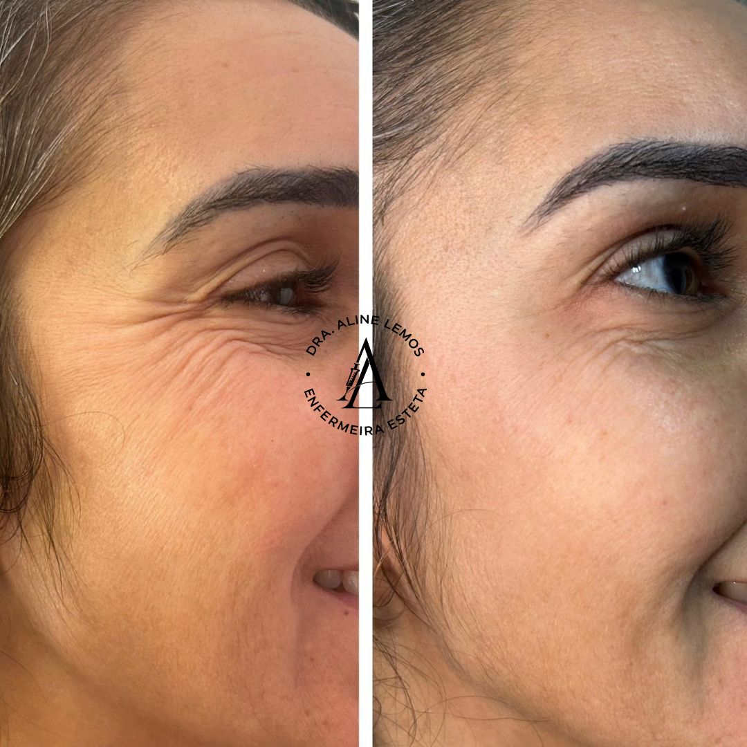 Antes e depois — Região dos olhos