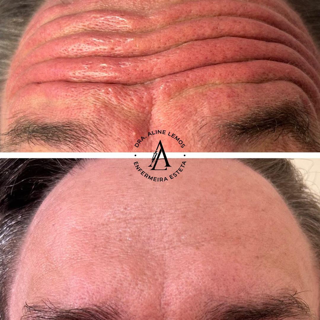 Antes e depois — Testa