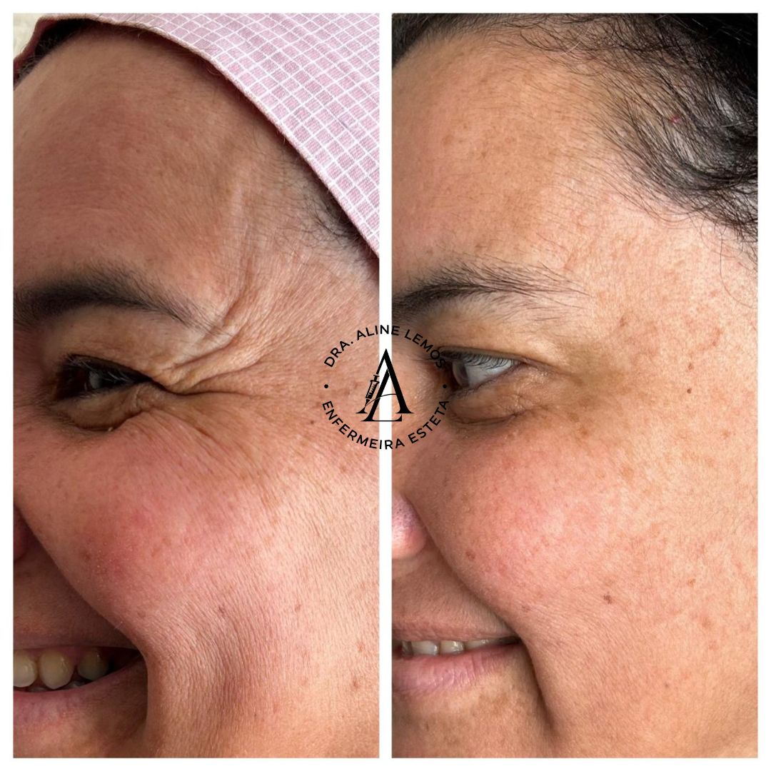 Antes e depois — Região dos olhos