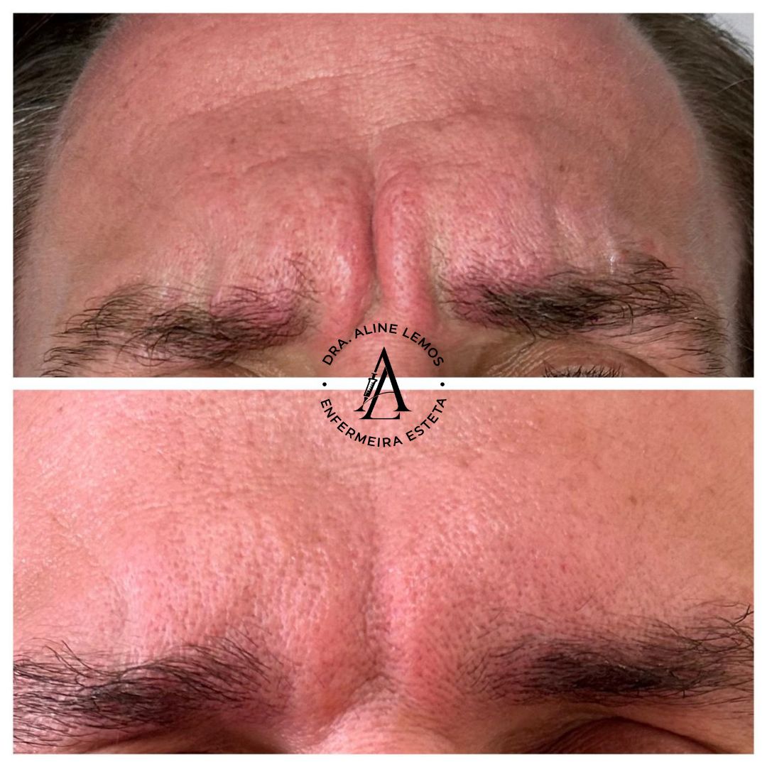 Antes e depois — Entre as sobrancelhas