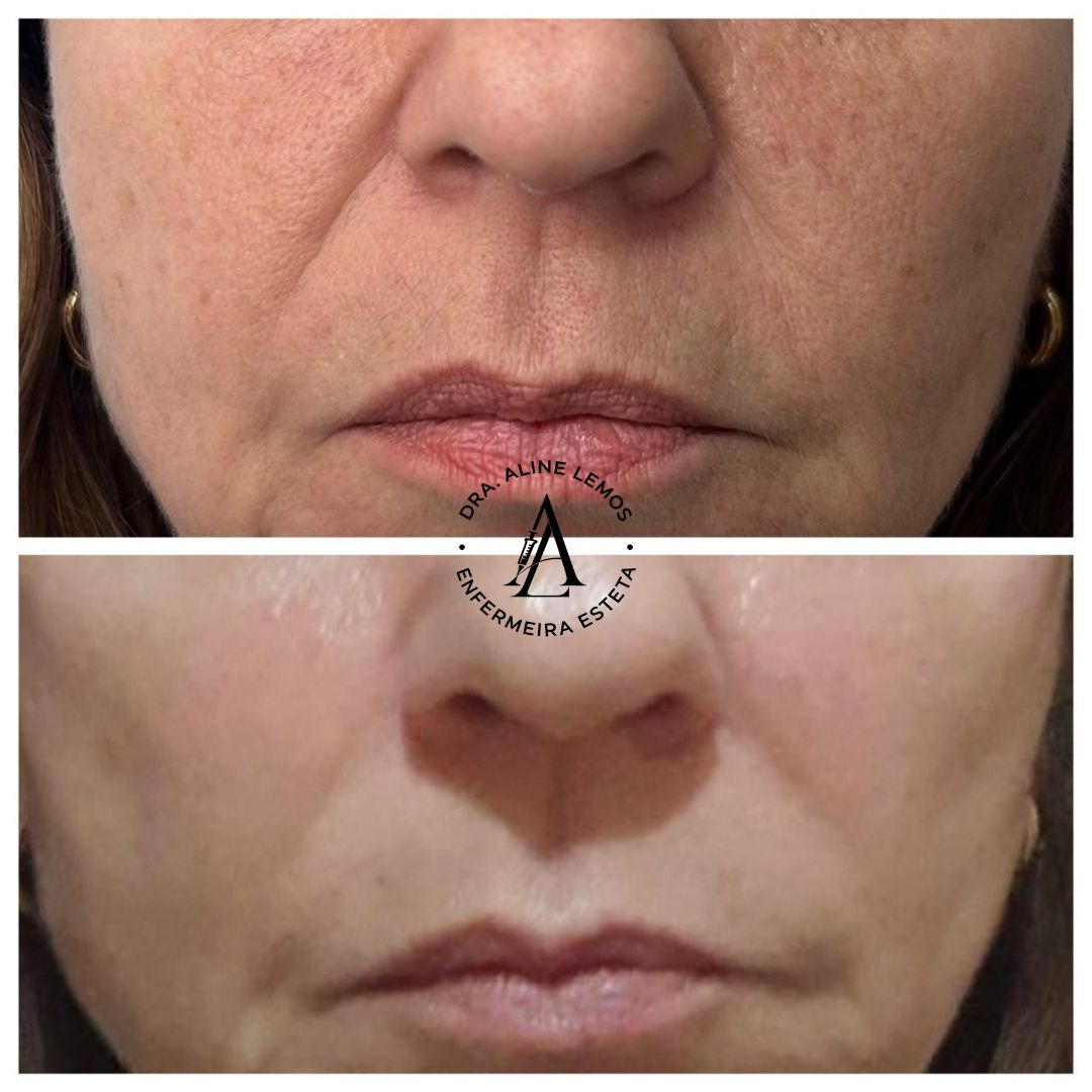 Antes e depois — Terço inferior da face