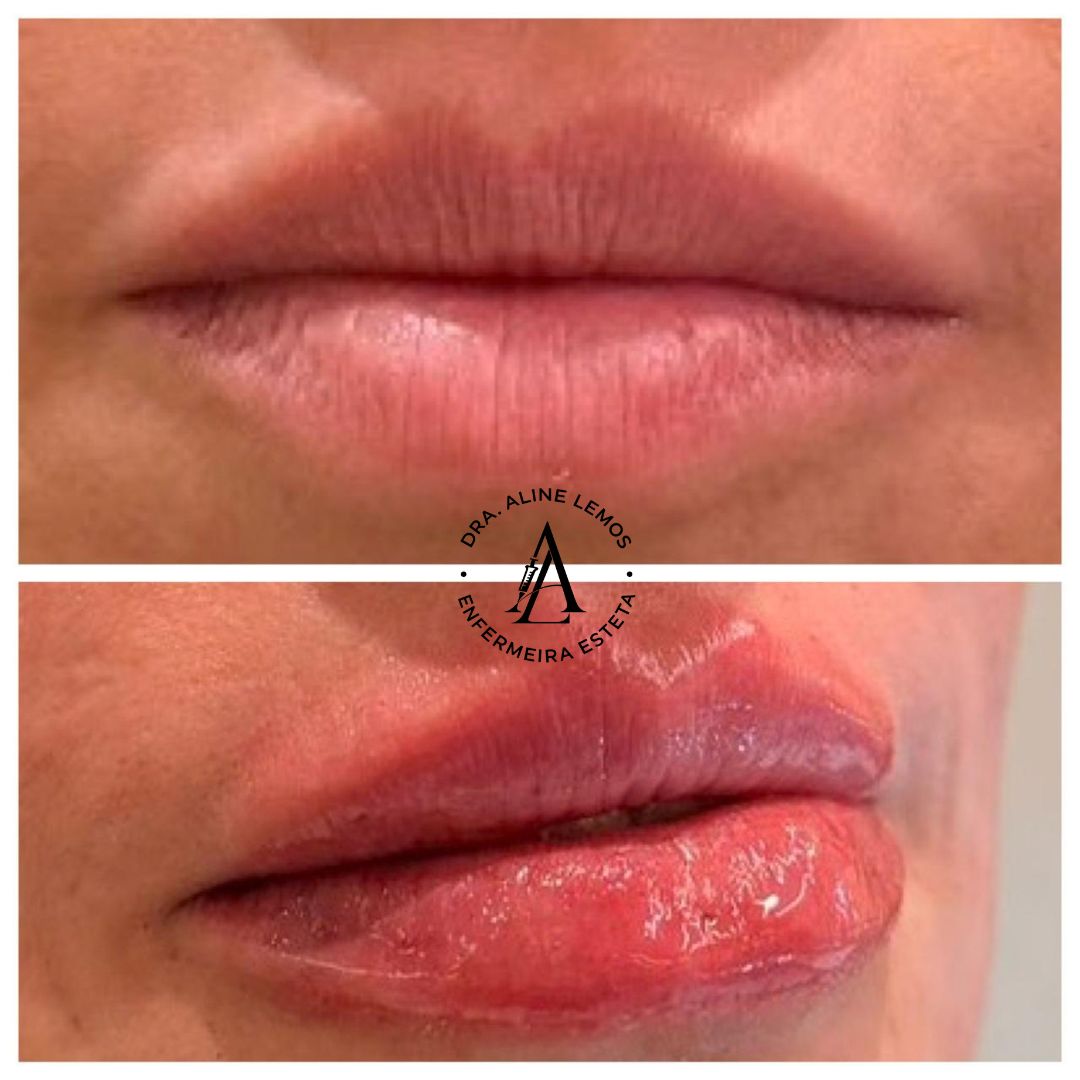 Antes e depois — Lábios