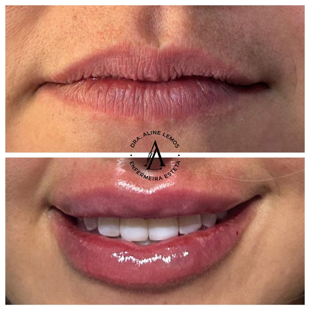 Antes e depois — Lábios