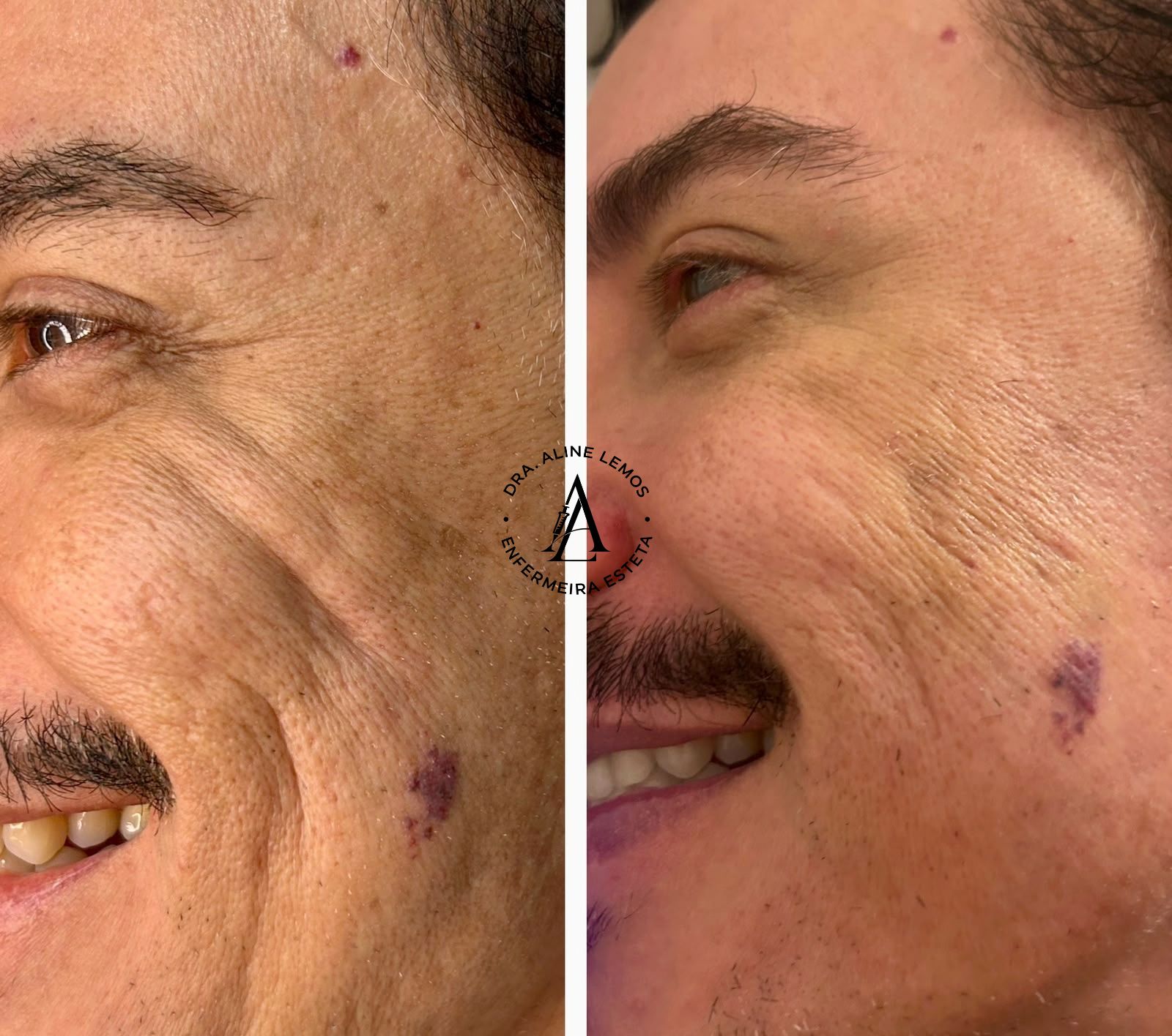 Antes e depois — Região dos olhos