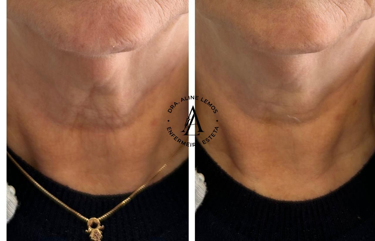 Antes e depois — Pescoço