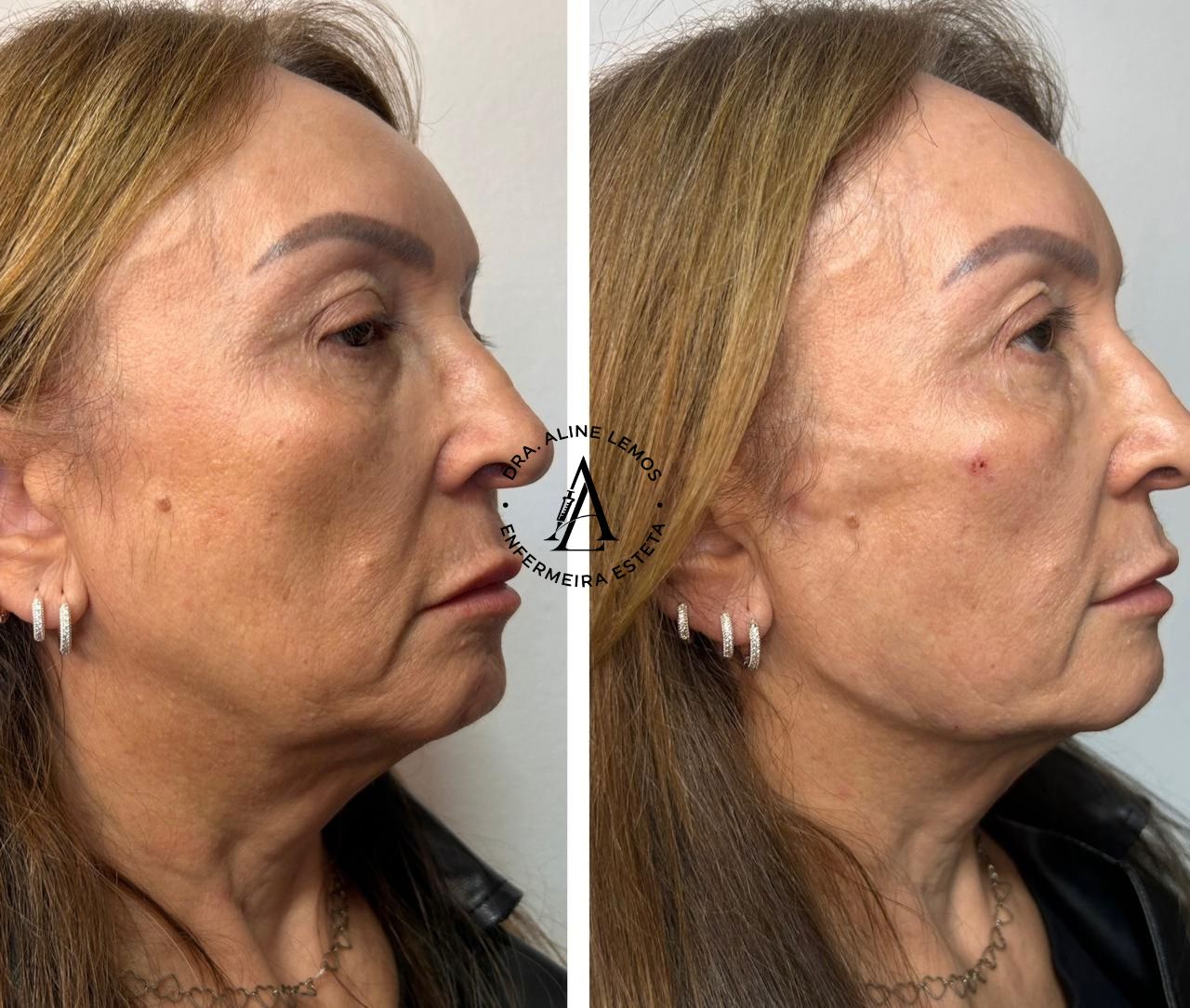 Antes e depois — Contorno facial